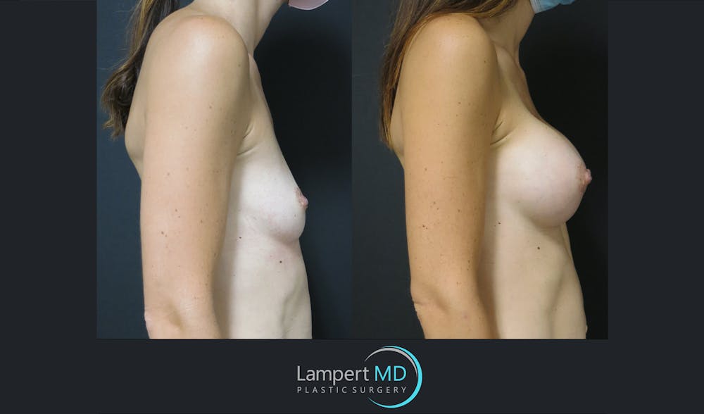 Breast Augmentation Before & After Gallery - Patient 143555840 - Image 4