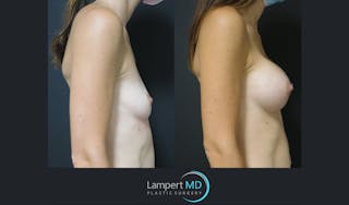 Breast Augmentation Before & After Gallery - Patient 143555840 - Image 4