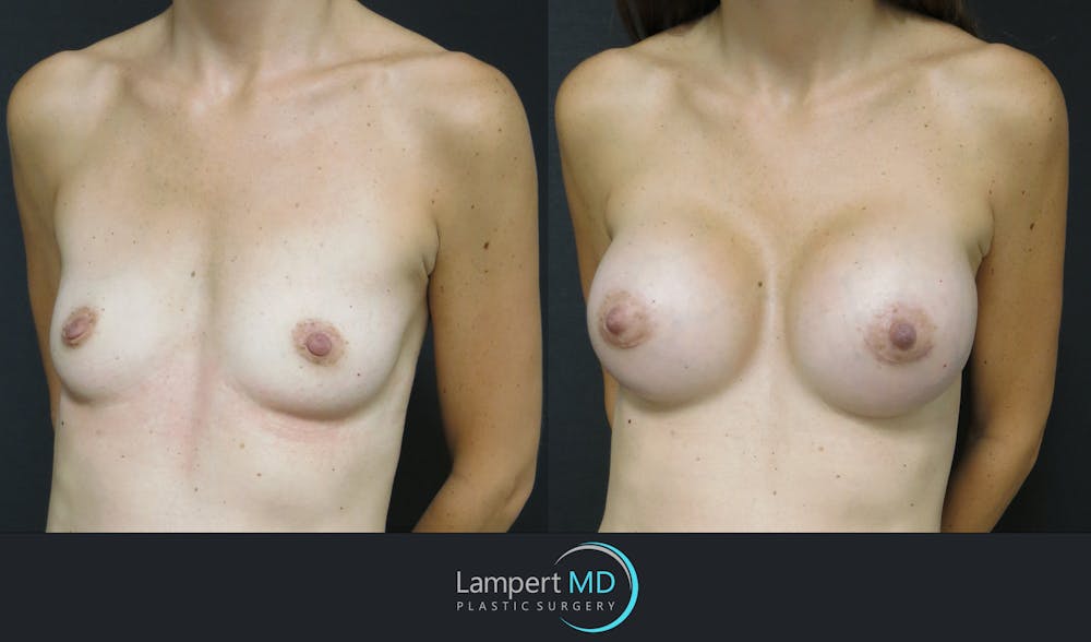 Breast Augmentation Before & After Gallery - Patient 143555840 - Image 5