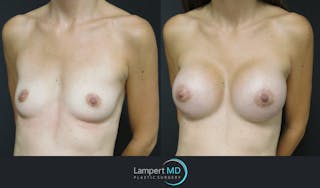 Breast Augmentation Before & After Gallery - Patient 143555840 - Image 5