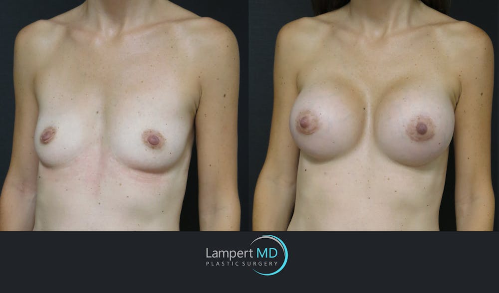 Breast Augmentation Before & After Gallery - Patient 143555840 - Image 6