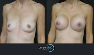 Breast Augmentation Before & After Gallery - Patient 143555840 - Image 6