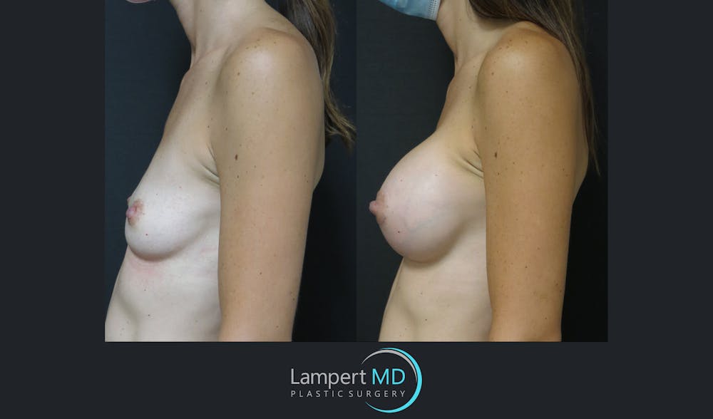 Breast Augmentation Before & After Gallery - Patient 143555840 - Image 7