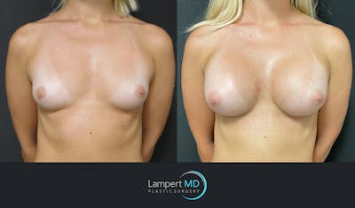 Breast Augmentation Before & After Gallery - Patient 143555920 - Image 1