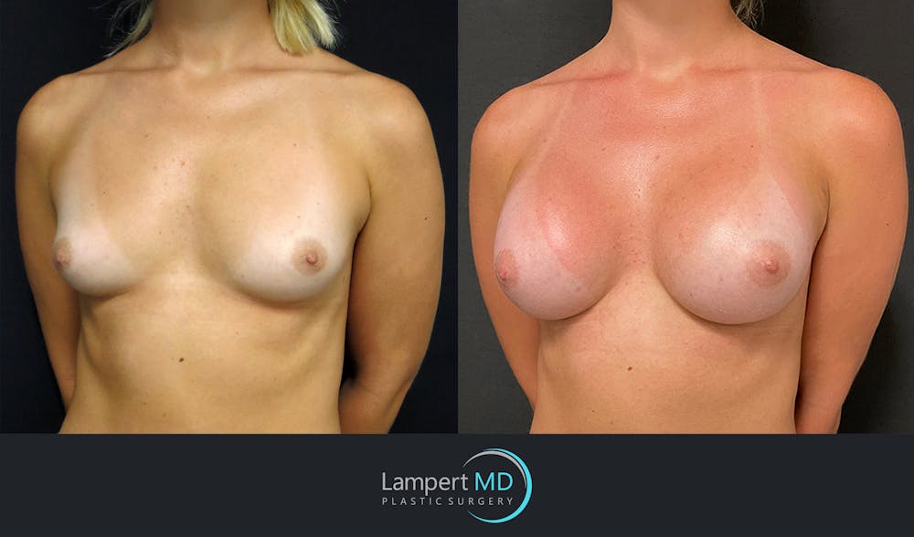 Breast Augmentation Before & After Gallery - Patient 143555920 - Image 2