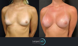 Breast Augmentation Before & After Gallery - Patient 143555920 - Image 2