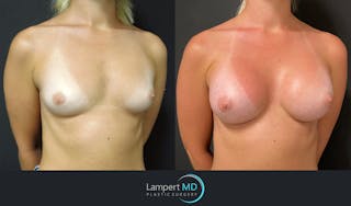 Breast Augmentation Before & After Gallery - Patient 143555920 - Image 3