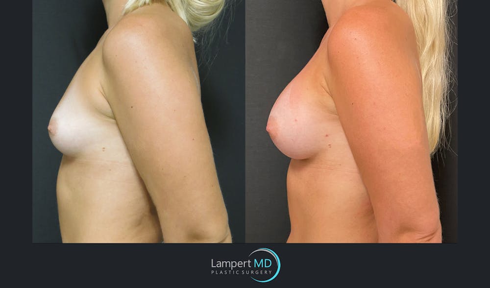 Breast Augmentation Before & After Gallery - Patient 143555920 - Image 4