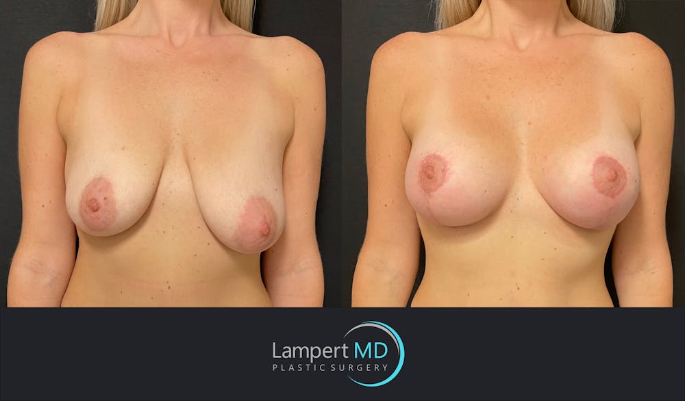 Breast Augmentation Before & After Gallery - Patient 143555976 - Image 1