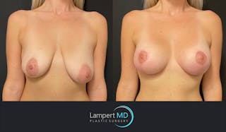 Breast Lift Before & After Gallery - Patient 143576256 - Image 1