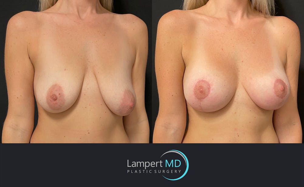 Breast Lift Before & After Gallery - Patient 143576256 - Image 2