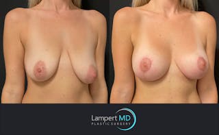 Breast Lift Before & After Gallery - Patient 143576256 - Image 2