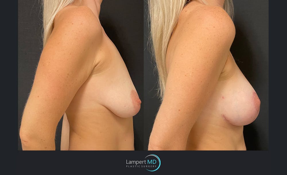 Breast Augmentation Before & After Gallery - Patient 143555976 - Image 3