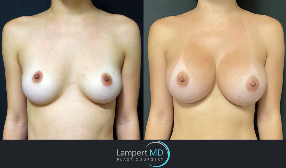 Breast Augmentation Before & After Gallery - Patient 143555986 - Image 1