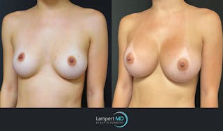 Breast Augmentation Before & After Gallery - Patient 143555986 - Image 2