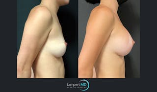 Breast Augmentation Before & After Gallery - Patient 143555986 - Image 3
