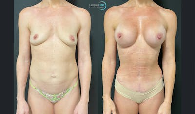 Mommy Makeover Before & After Gallery - Patient 143556262 - Image 1