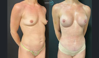 Mommy Makeover Before & After Gallery - Patient 143556262 - Image 2