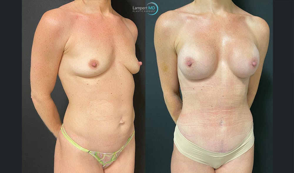 Breast Augmentation Before & After Gallery - Patient 149147951 - Image 2