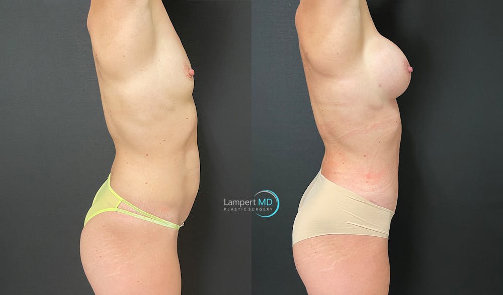 Tummy Tuck Before & After Gallery - Patient 142763120 - Image 3