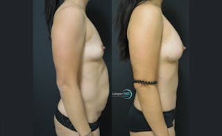 Breast Augmentation Before & After Gallery - Patient 143556126 - Image 3