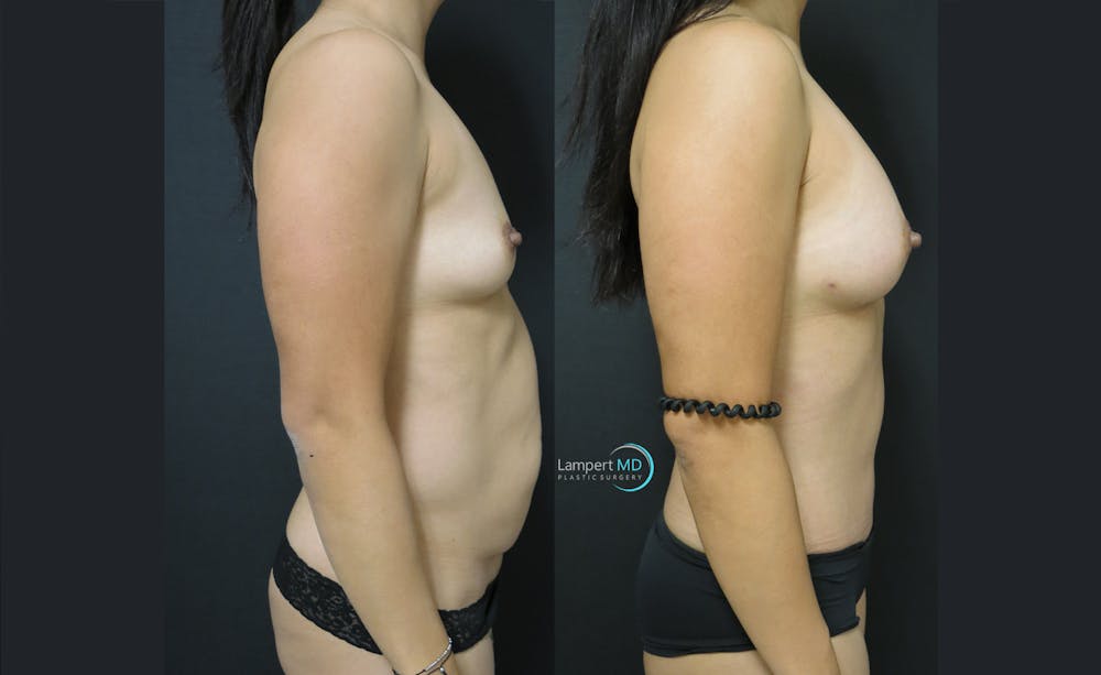 Breast Augmentation Before & After Gallery - Patient 143556126 - Image 3