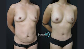 Mommy Makeover Before & After Gallery - Patient 143556264 - Image 3