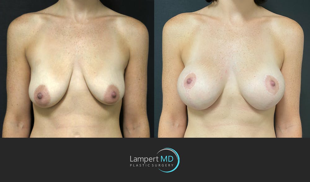 Breast Lift Before & After Gallery - Patient 143576255 - Image 1