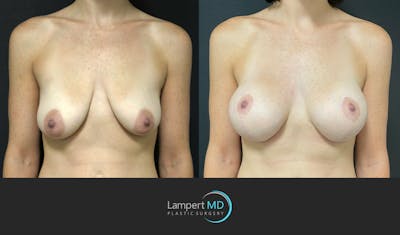 Breast Lift Before & After Gallery - Patient 143576255 - Image 1