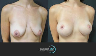 Breast Lift Before & After Gallery - Patient 143576255 - Image 2