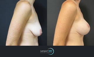 Breast Lift Before & After Gallery - Patient 143576255 - Image 3