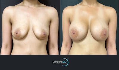 Breast Augmentation Before & After Gallery - Patient 143556134 - Image 1