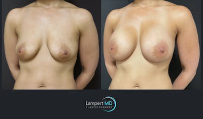 Breast Augmentation Before & After Gallery - Patient 143556134 - Image 2