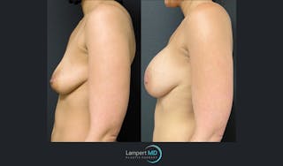 Breast Augmentation Before & After Gallery - Patient 143556134 - Image 3