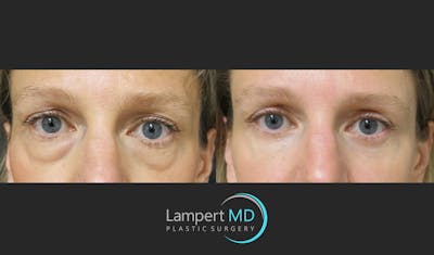 Facial Fat Grafting Before & After Gallery - Patient 143556225 - Image 1