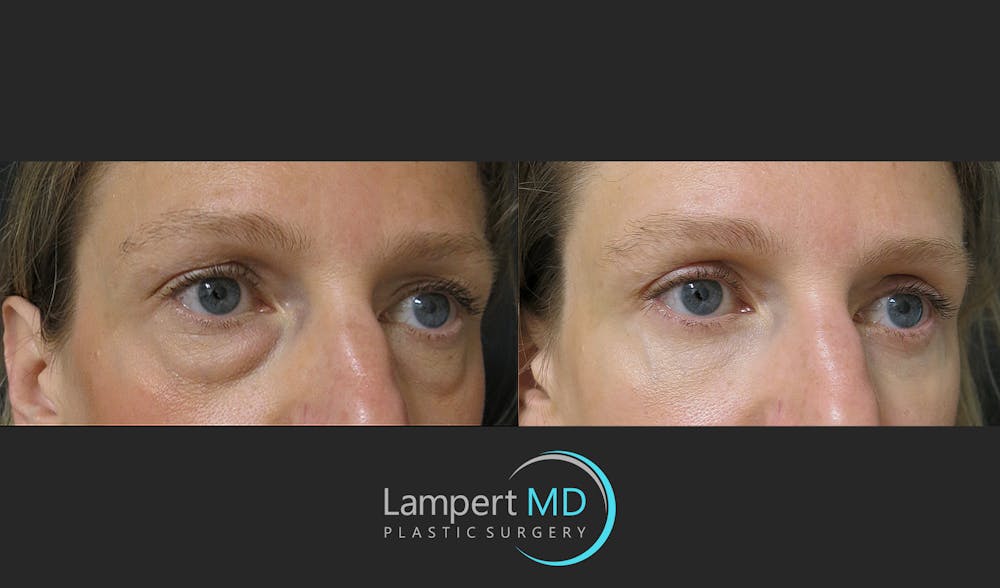 Facial Fat Grafting Before & After Gallery - Patient 143556225 - Image 2