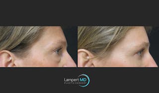 Facial Fat Grafting Before & After Gallery - Patient 143556225 - Image 3