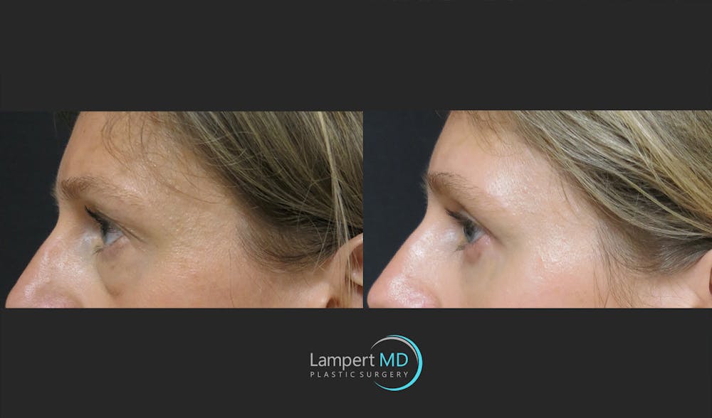 Eyelid Surgery Before & After Gallery - Patient 165636364 - Image 4