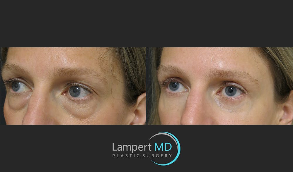 Eyelid Surgery Before & After Gallery - Patient 165636364 - Image 5
