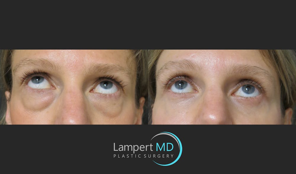 Eyelid Surgery Before & After Gallery - Patient 165636364 - Image 6