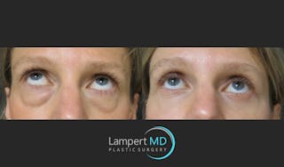 Eyelid Surgery Before & After Gallery - Patient 165636364 - Image 6