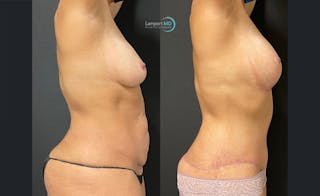 Mommy Makeover Before & After Gallery - Patient 148735019 - Image 3