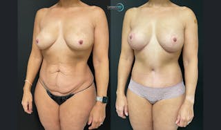 Mommy Makeover Before & After Gallery - Patient 148735019 - Image 4