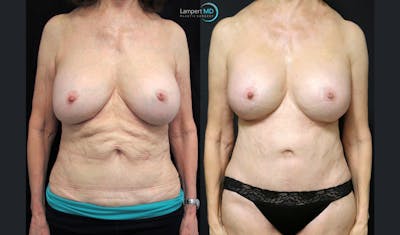 Mommy Makeover Before & After Gallery - Patient 143556241 - Image 1