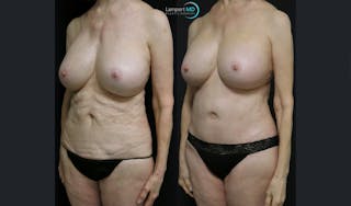 Mommy Makeover Before & After Gallery - Patient 143556241 - Image 2