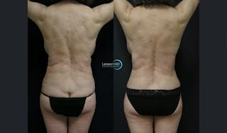 Mommy Makeover Before & After Gallery - Patient 143556241 - Image 4