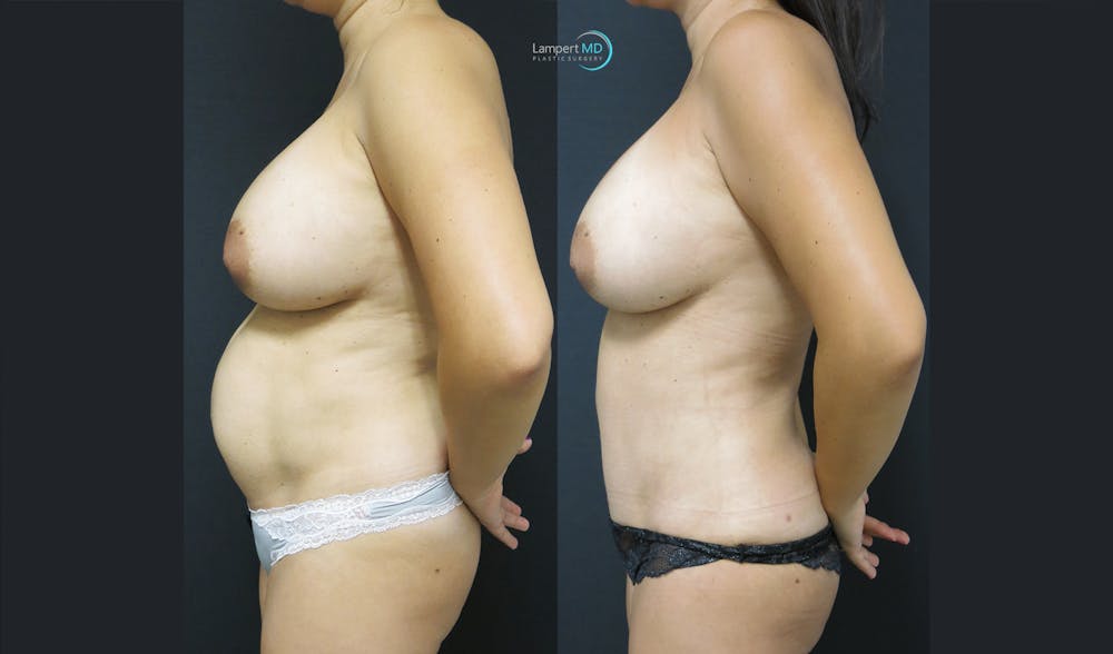 Mommy Makeover Before & After Gallery - Patient 143556253 - Image 3