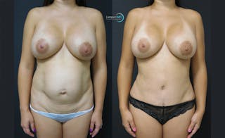 Mommy Makeover Before & After Gallery - Patient 143556253 - Image 1