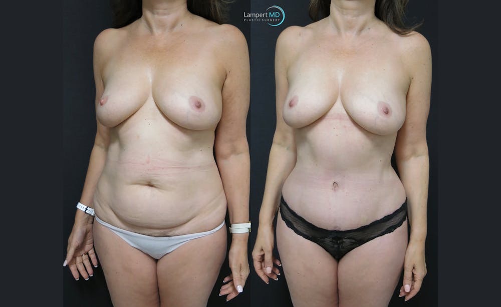 Mommy Makeover Before & After Gallery - Patient 143556256 - Image 2