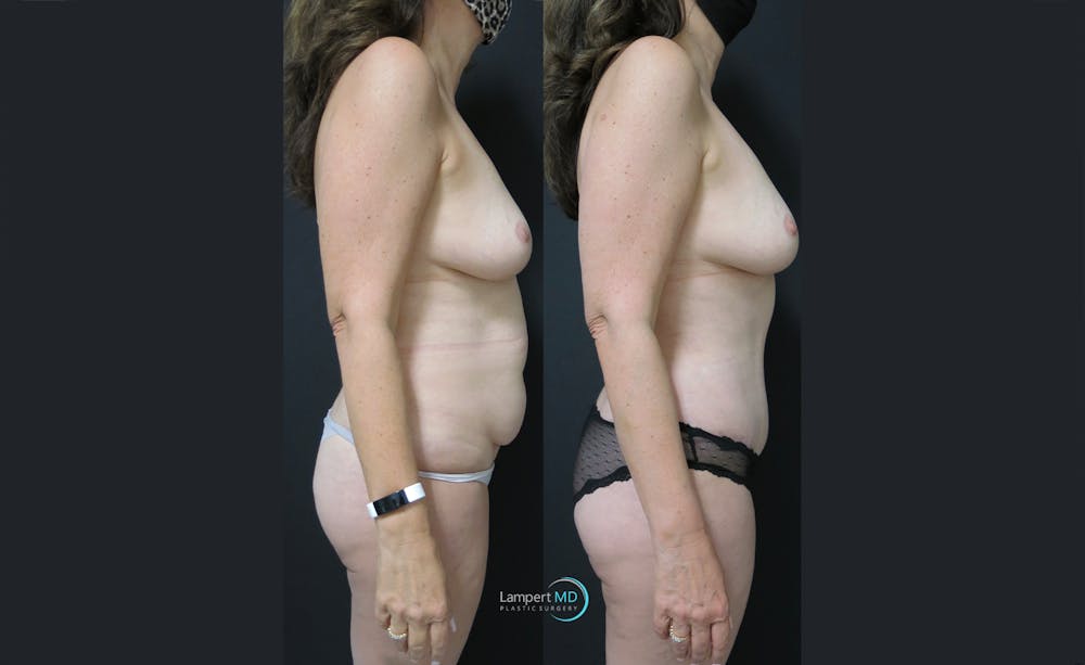 Mommy Makeover Before & After Gallery - Patient 143556256 - Image 4